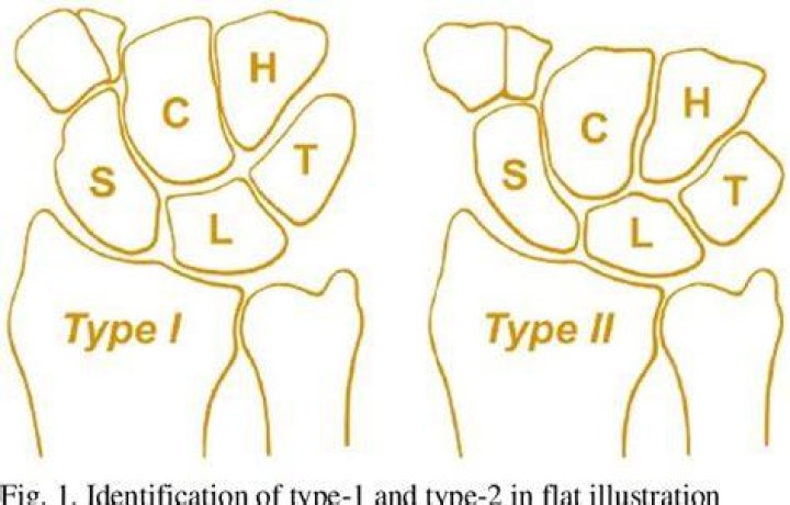 What is type 2 lunate?