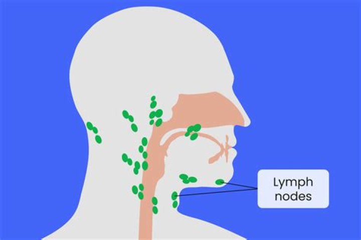 Whats a swollen lymph node?