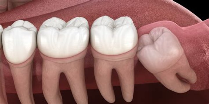 Whats an impacted molar?