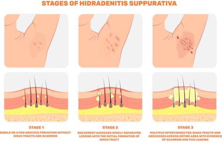 When does hidradenitis suppurativa stop?