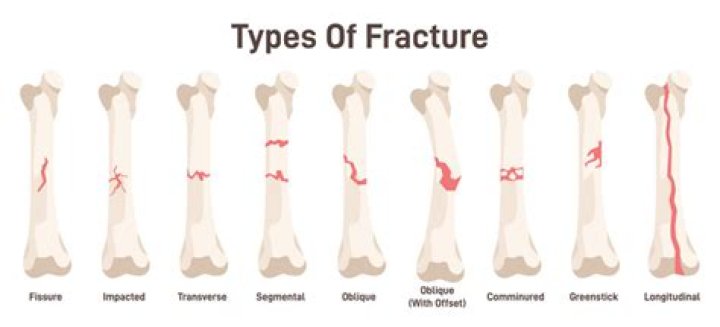 When does impacted fracture occur?