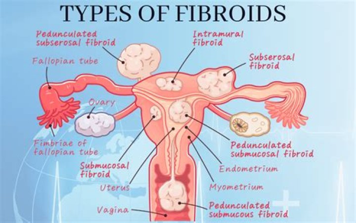 When fibroids degenerate do they bleed?