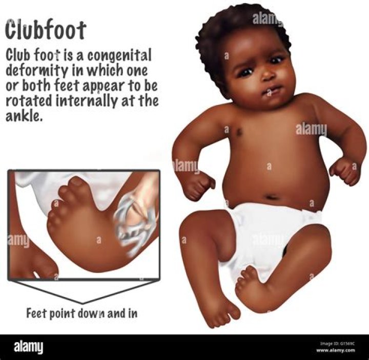 When is clubfoot detected?