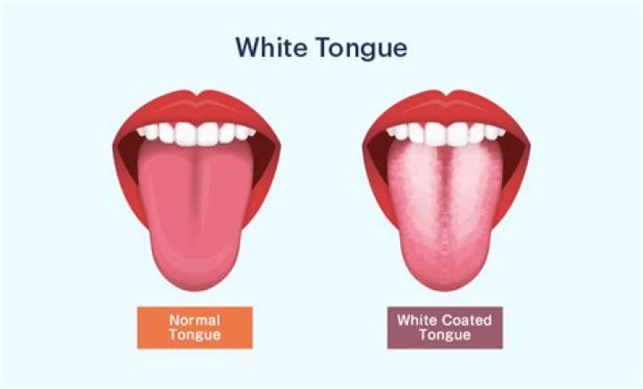 When tongue is white what does that mean?