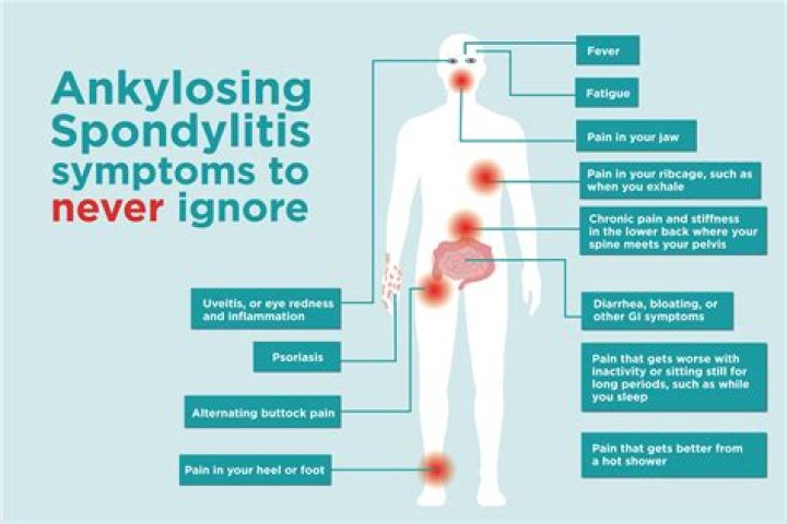 Where do spondylitis come from?