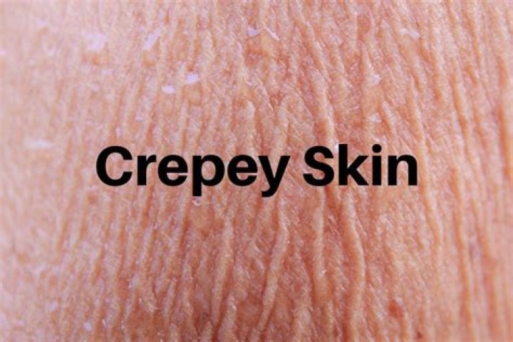 Where does crepey skin come from?
