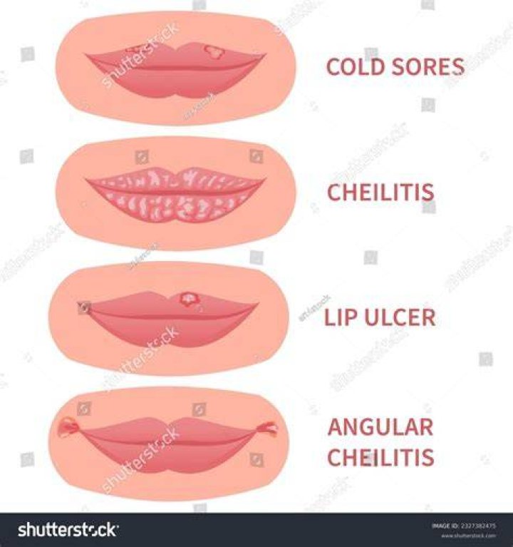 Where is cheilosis found?