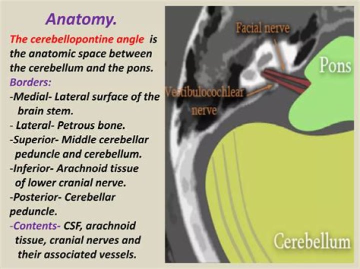 Where is the left cerebellopontine angle?