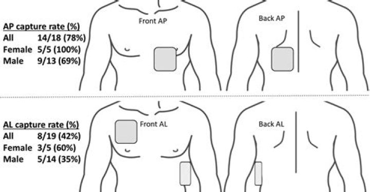 Where should aed pads be placed anterolateral?