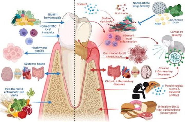 Which bacteria cause periodontitis?