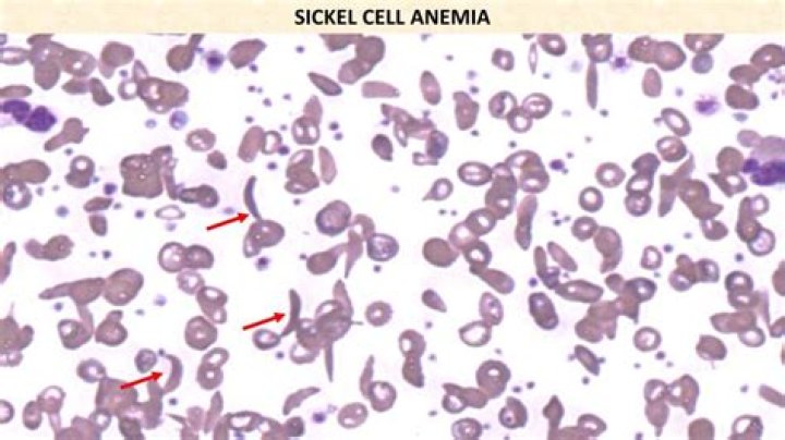 Which codon in the sickle cell dna is altered?