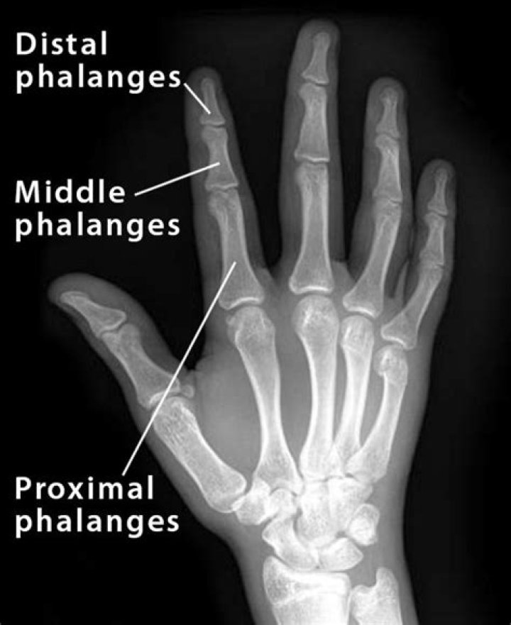 Which finger lacks a middle phalanx?