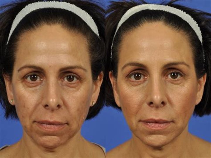 Which juvederm for tear trough?