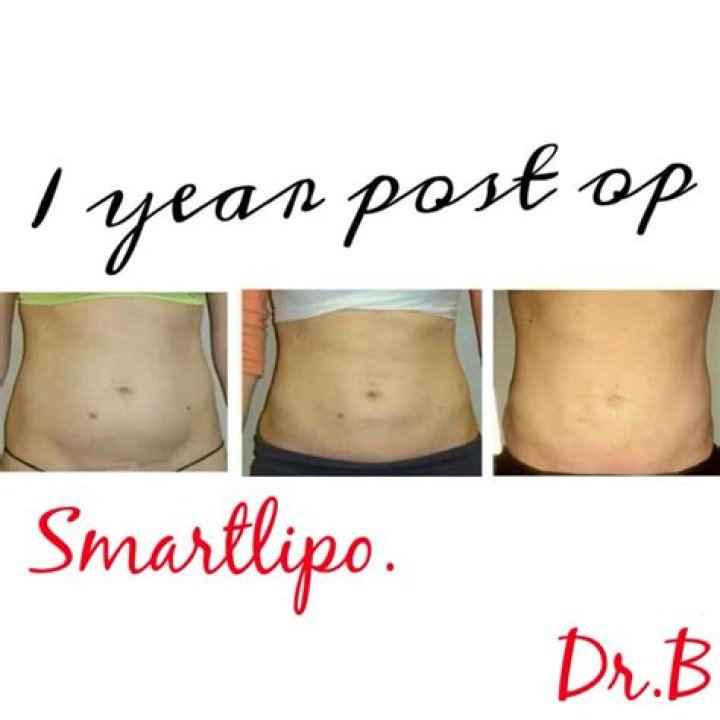 Who is smart lipo?