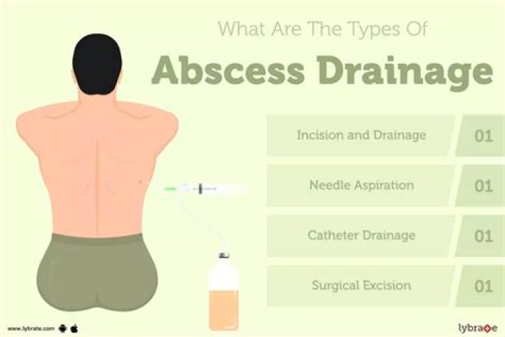 Why abscess drainage is done?
