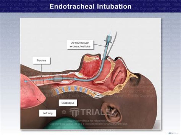 Why is intubation so hard?