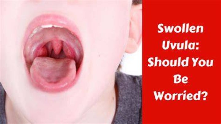 Why is my uvula really swollen?