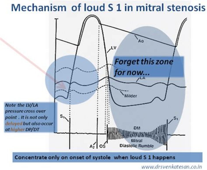 Why mitral stenosis loud s1?