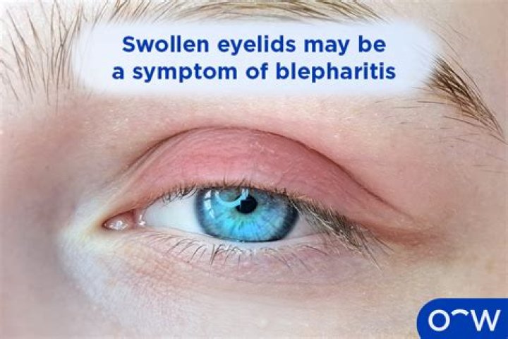 Why won't my blepharitis go away?