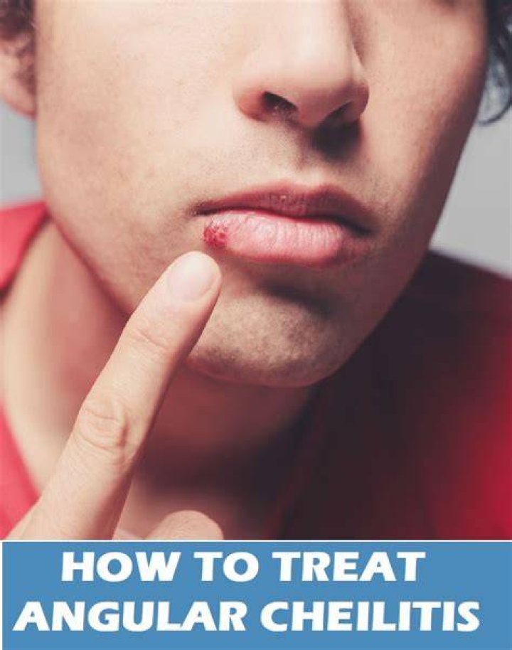 Will angular cheilitis go away?