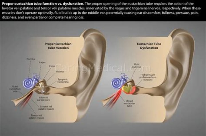 Will prednisone help eustachian tube dysfunction?