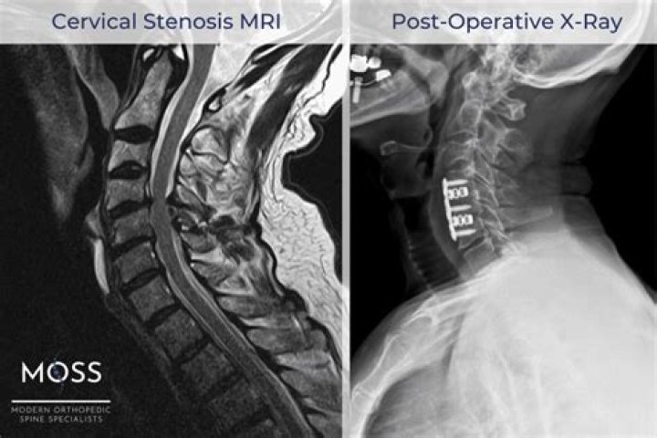 Will steroids help degenerative myelopathy?