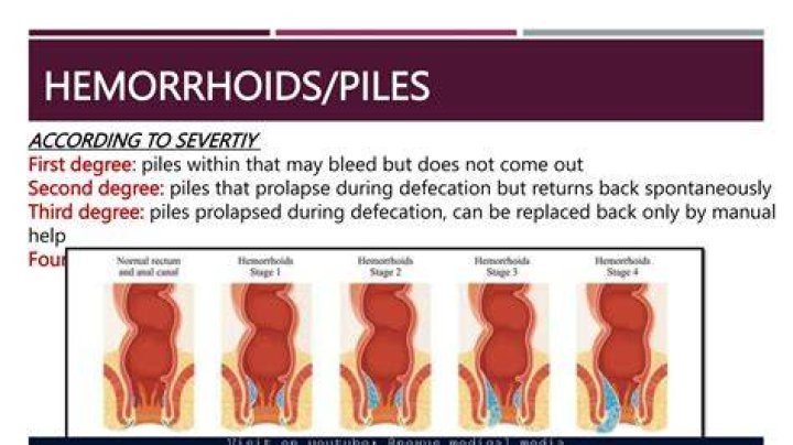 Would hemorrhoids cause lower back pain?